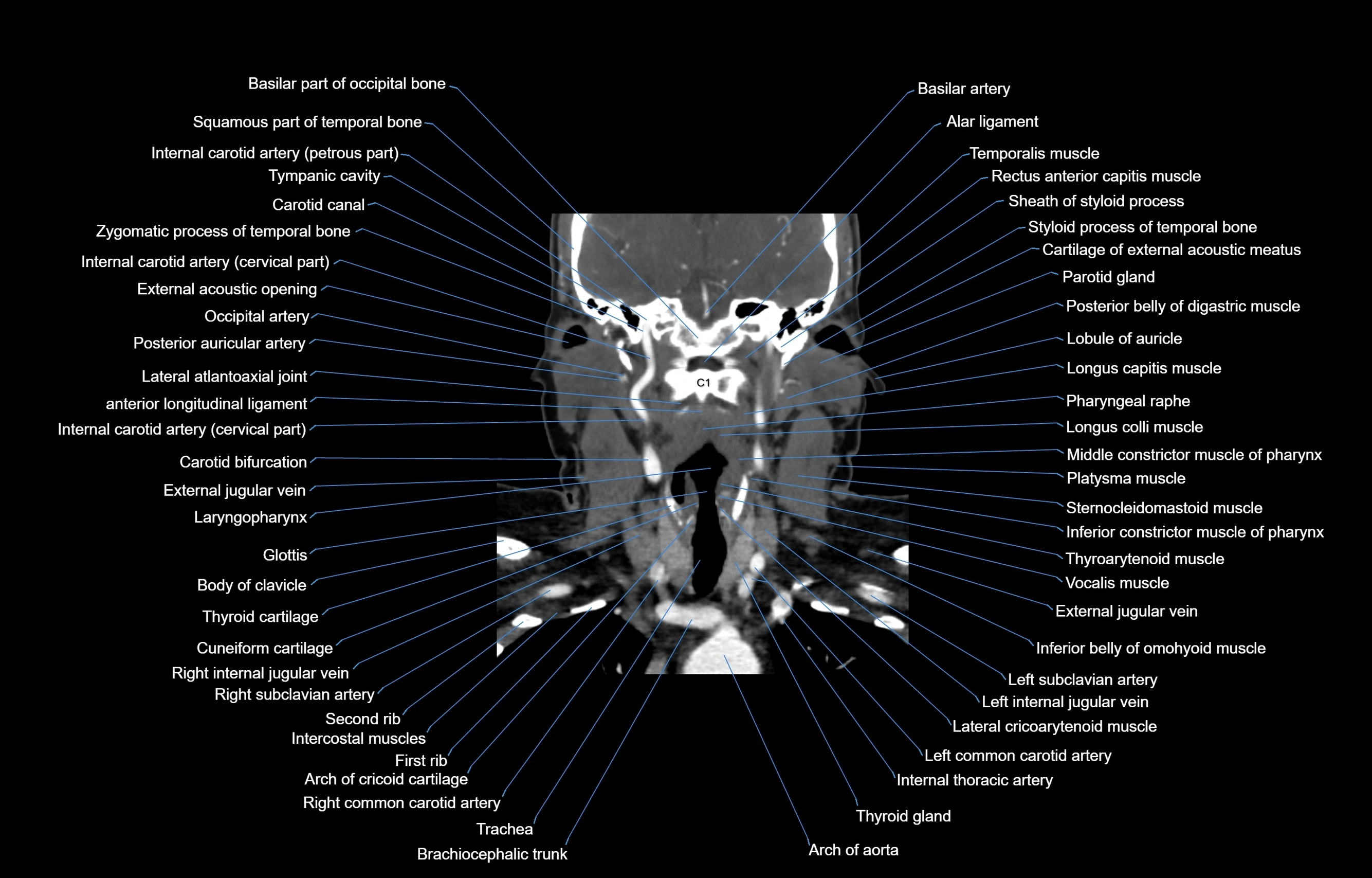 CT Neck coronal  cross sectional anatomy labelled 3D  radiology  image-00036.webp